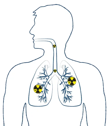 Zeichnung einer Person, bei der die Lungen abgebildet sind und das Radon-Gefahrensymbol eingezeichnet ist.